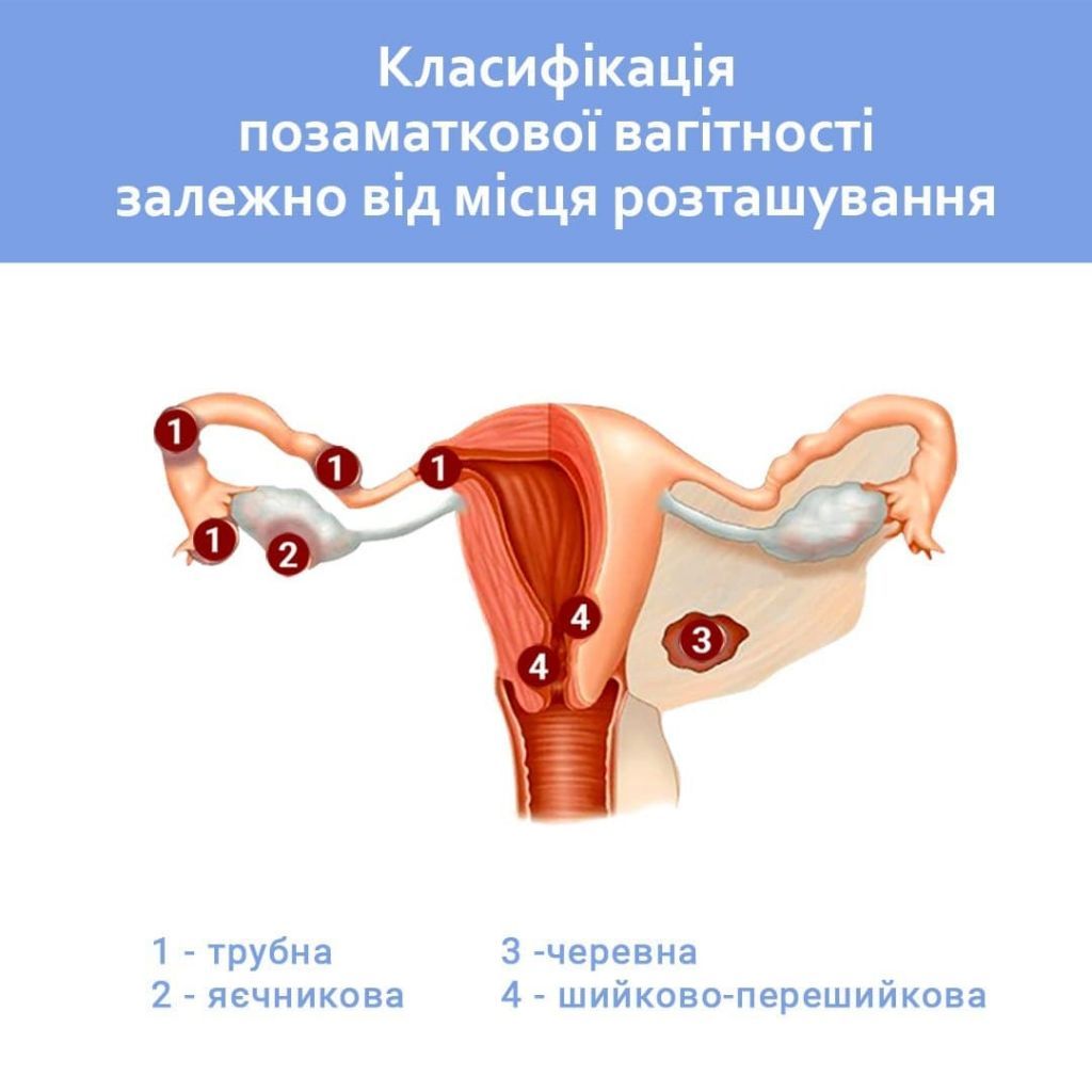 Позаматкова вагітність, класифікація та випадки Позаматкова вагітність, класифікація та випадки