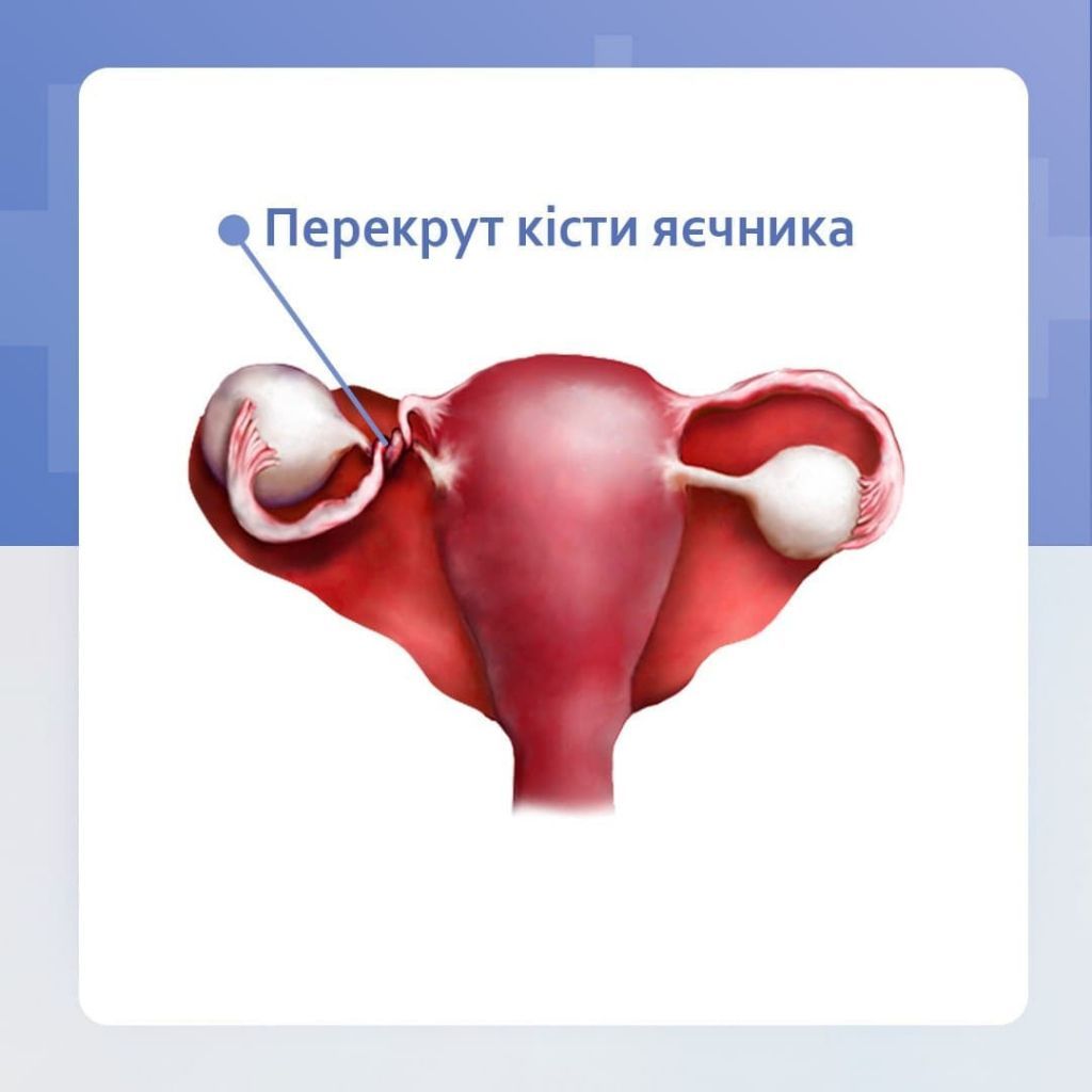 Перекрут кісти яєчника Перекрут кісти яєчника