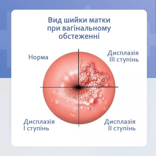Дисплазія шийки матки. Що це? Симптоми, діагностування та лікування. Дисплазія шийки матки. Що це? Симптоми, діагностування та лікування.