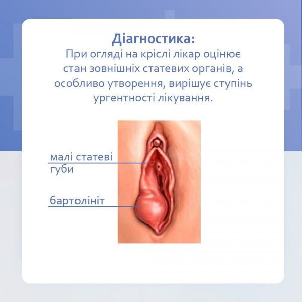 Проблеми бартолінової залози Причини, симптоми, діагностика, лікування Проблеми бартолінової залози Причини, симптоми, діагностика, лікування